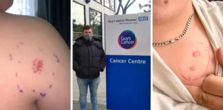 Inglaterra: joven confundió síntomas de cáncer con alergia. Impactante revelación.