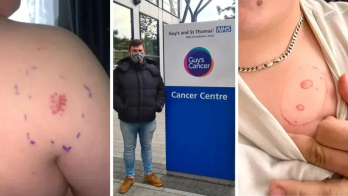 Inglaterra: joven confundió síntomas de cáncer con alergia. Impactante revelación. Inglaterra: joven confundió síntomas de cáncer con alergia. Impactante revelación.