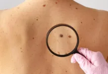 Nuevas pautas para prevenir el cáncer de piel y cuidar tu salud.