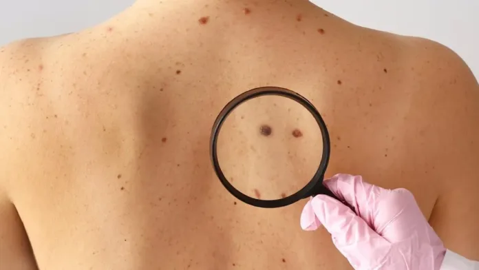 Nuevas pautas para prevenir el cáncer de piel y cuidar tu salud. Nuevas pautas para prevenir el cáncer de piel y cuidar tu salud.