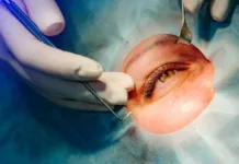 Cirugía ocular para cambiar el color: costos y riesgos que debes conocer.
