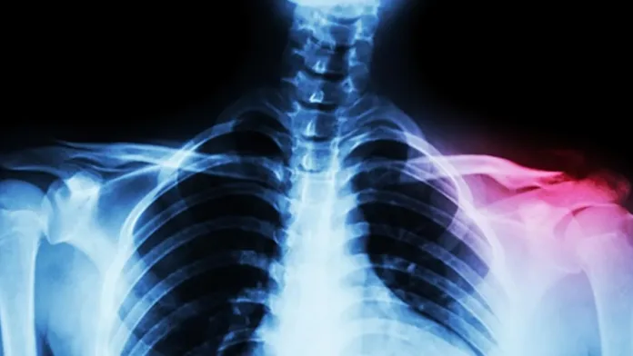 Tiempo de recuperación de una fractura de clavícula: ¿cuánto dura el proceso? Tiempo de recuperación de una fractura de clavícula: ¿cuánto dura el proceso?