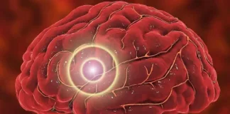 El riesgo de accidente cerebrovascular aumenta tras ataques menores similares.