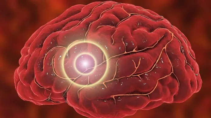 El riesgo de accidente cerebrovascular aumenta tras ataques menores similares. El riesgo de accidente cerebrovascular aumenta tras ataques menores similares.
